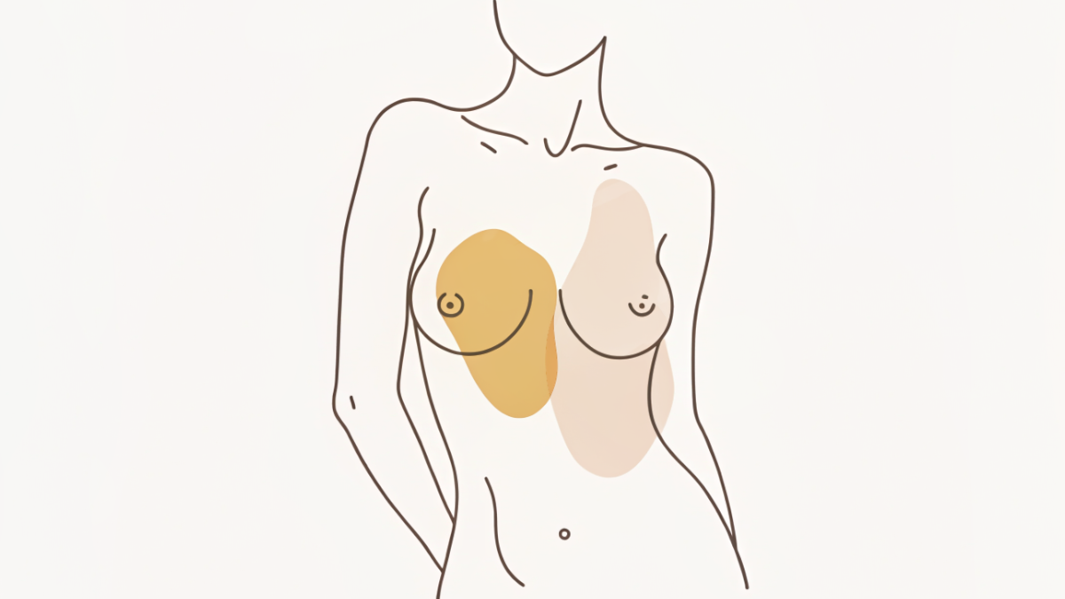 What is Capsular Contracture?