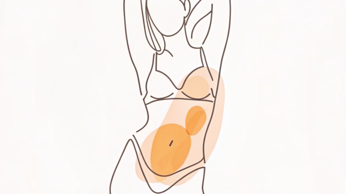 Surgery for Split Muscle Repair After Pregnancy