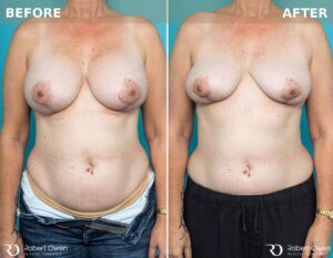 7296 Pre Post Breast Implant Removal 6 Week F