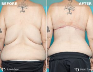 7756 3 Months Post op Back Lift