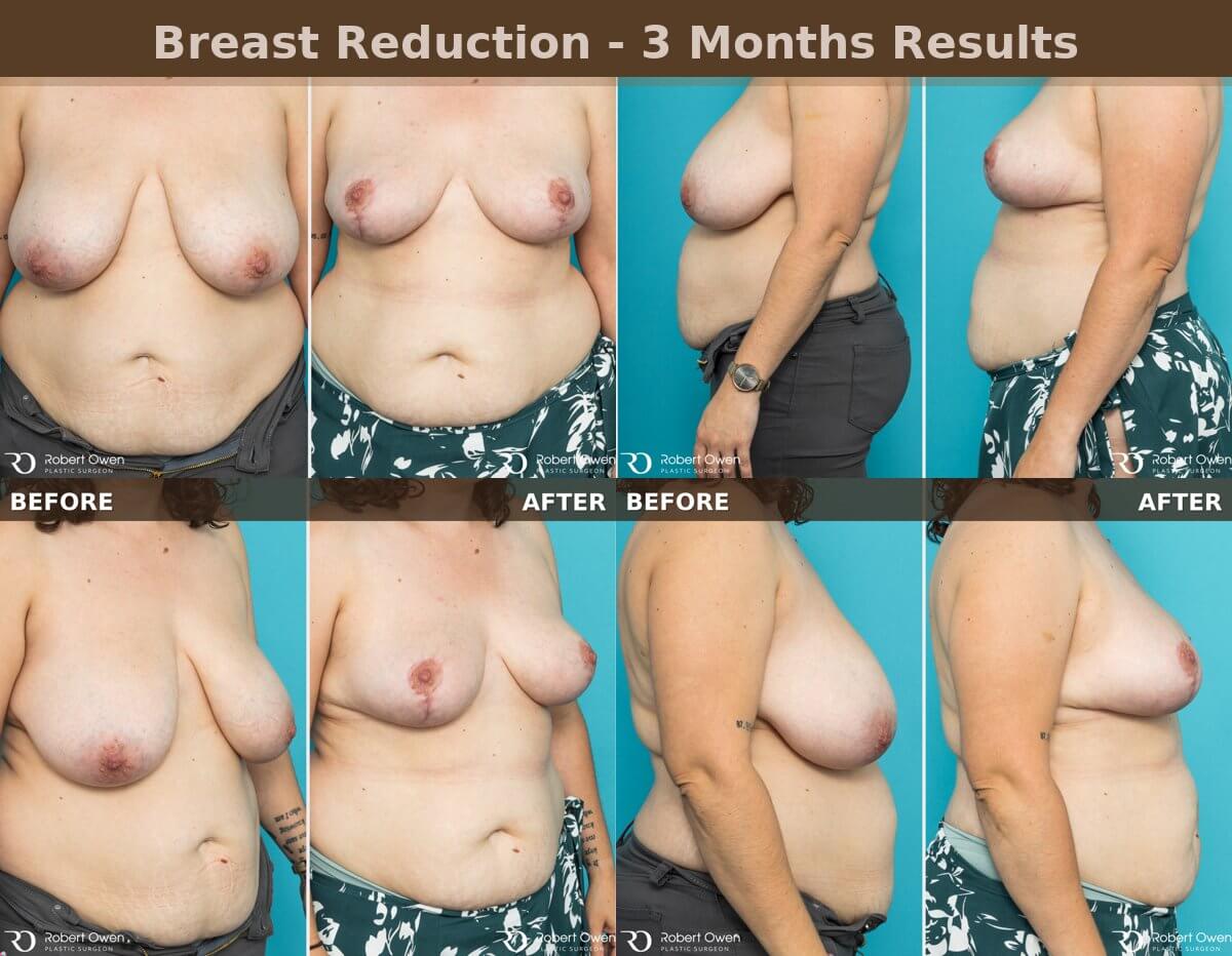 Breast reduction patient progress after 3 months showing smaller, lifted breasts.