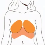 What Happens If You Leave Breast Implants In Too Long by Dr Robert Owen