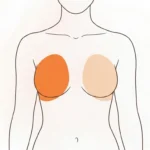 Will My Breasts Sag After Explant Surgery A Specialist Approach with Dr Robert Owen